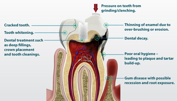 Ευαισθησία των δοντιών – Αιτίες και αντιμετώπιση
